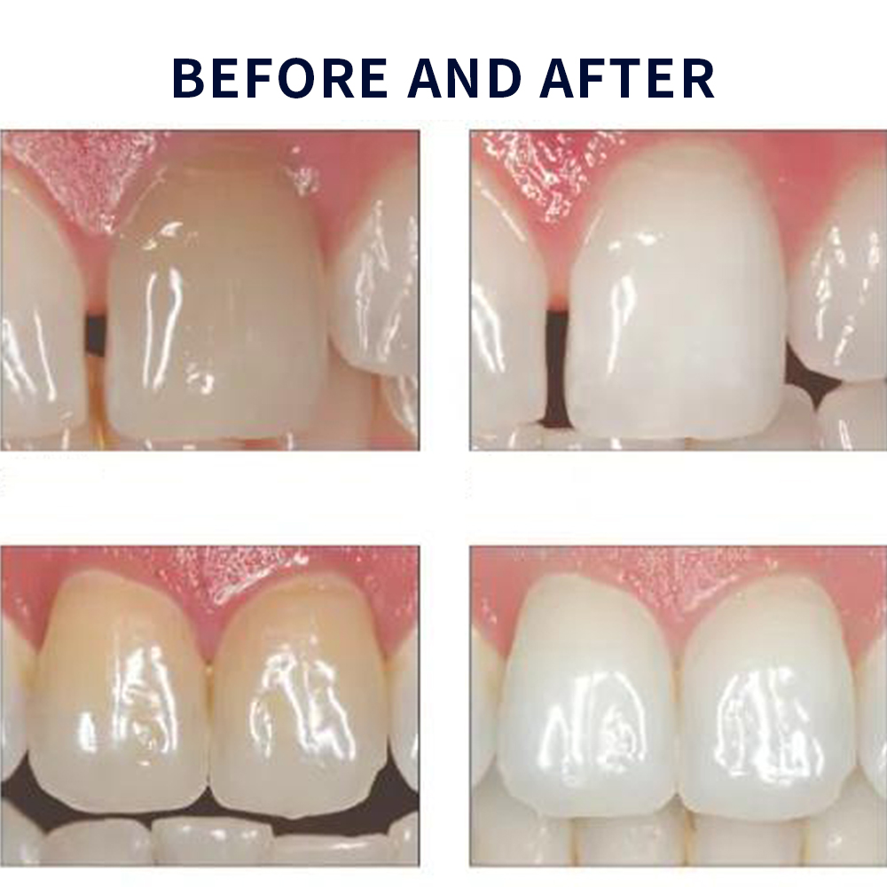 Opalwisdom-Kit de Blanchiment  - Teeth Whitening Results avis et prix