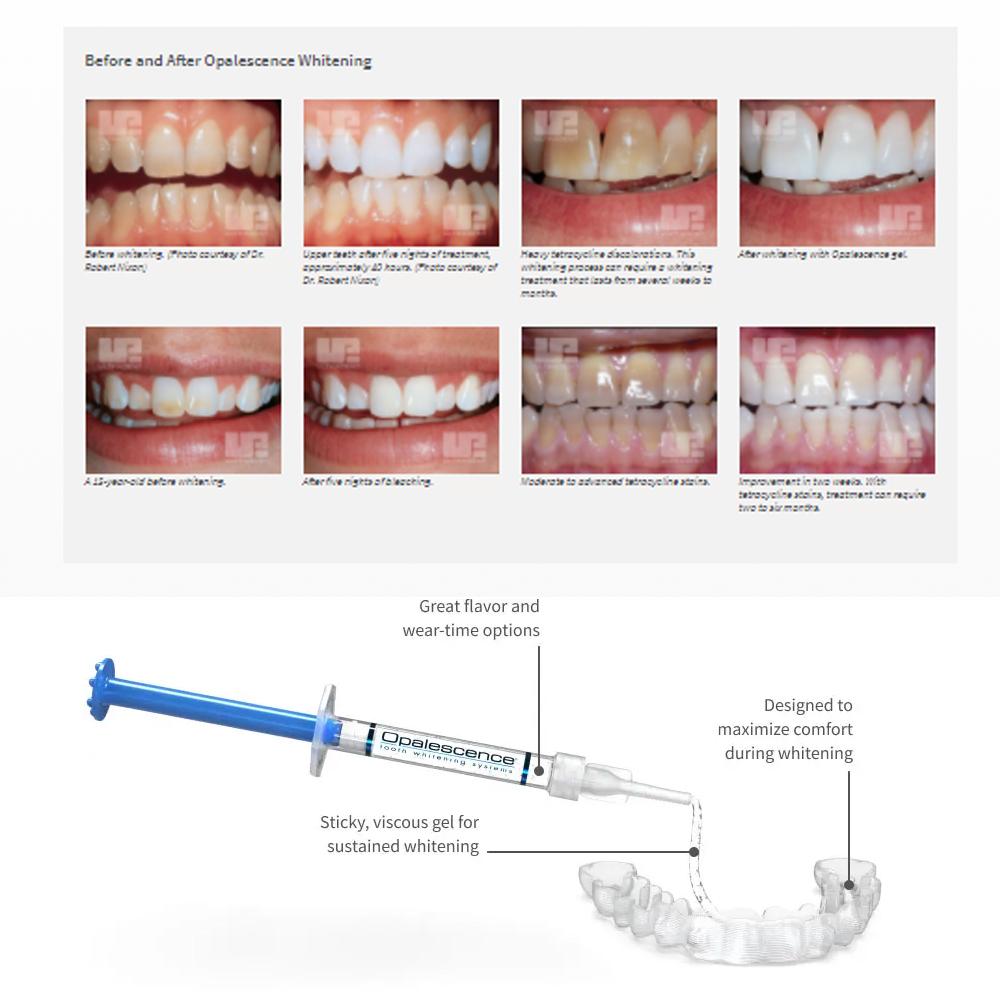 Opalwisdom-Kit de Blanchiment  - Teeth Whitening Results avis et prix