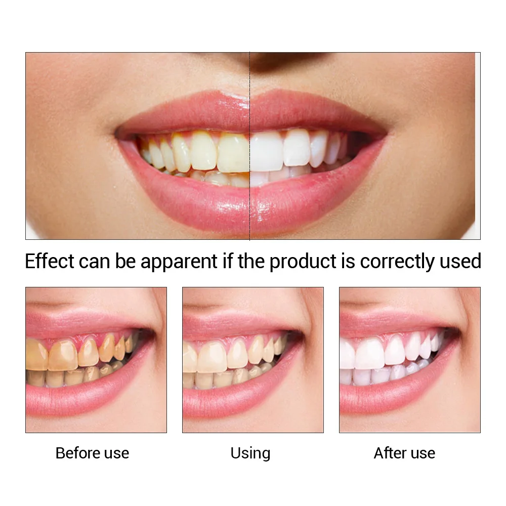 FTEENPLY poudre d'essence de b - Teeth Whitening Street avis et prix